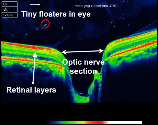 Optic nerve OCT