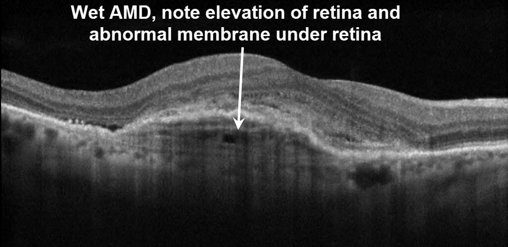 wet amd oct