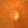 glaucoma optic nerve